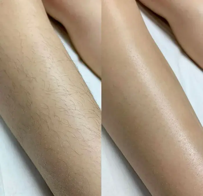 Leg laser hair removal before and after