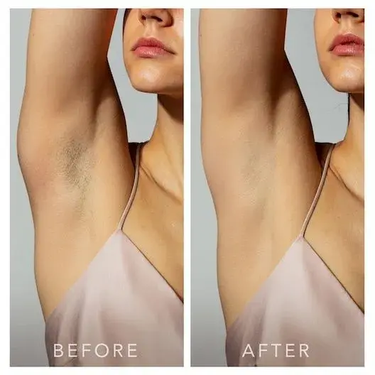 Underarm laser hair removal before and after