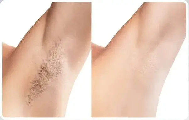 Underarm laser hair removal before and after, second patient